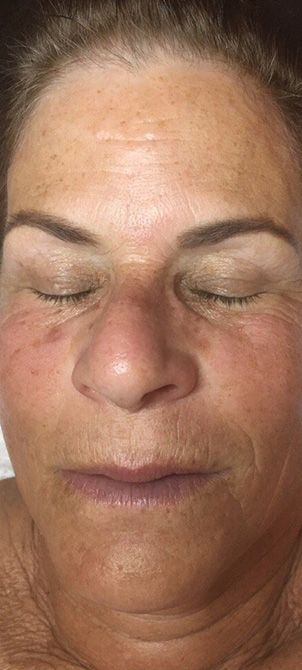 After image of a Crystal Clear Microdermabrasion session