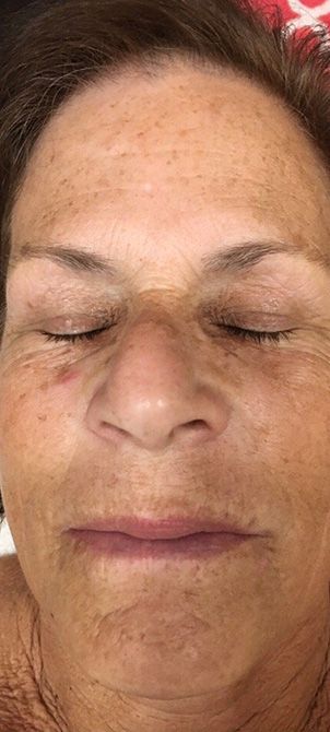 Before image of a Crystal Clear Microdermabrasion session