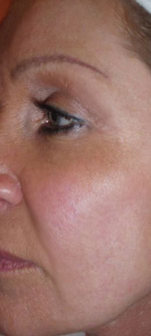 After image of a Micro-Current Face Lift session