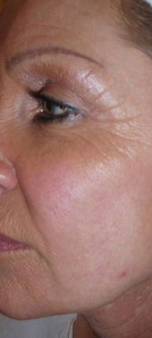 Before image of a Micro-Current Face Lift session