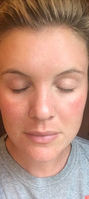 After image of a Dermapen Microneedling session