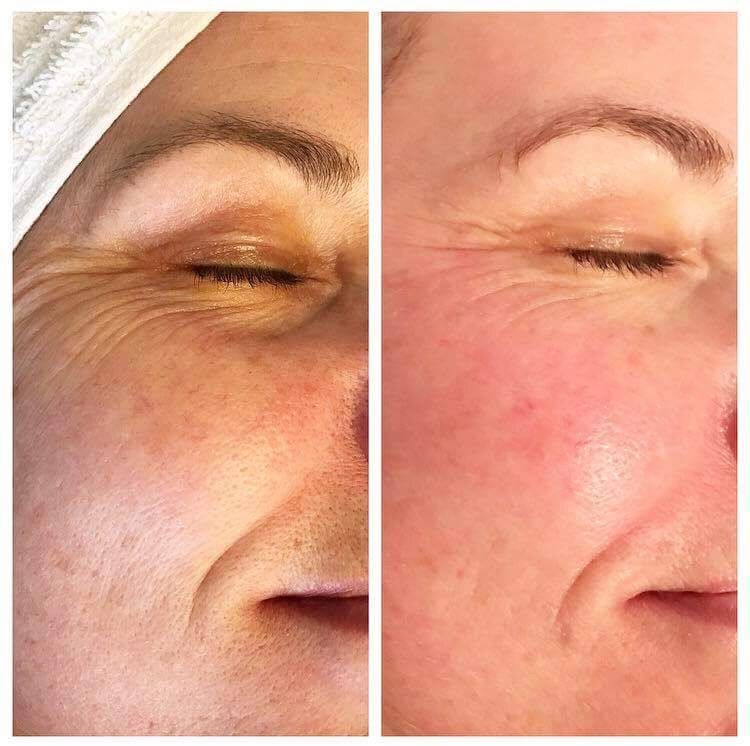 After image of a Crystal Clear Microdermabrasion session